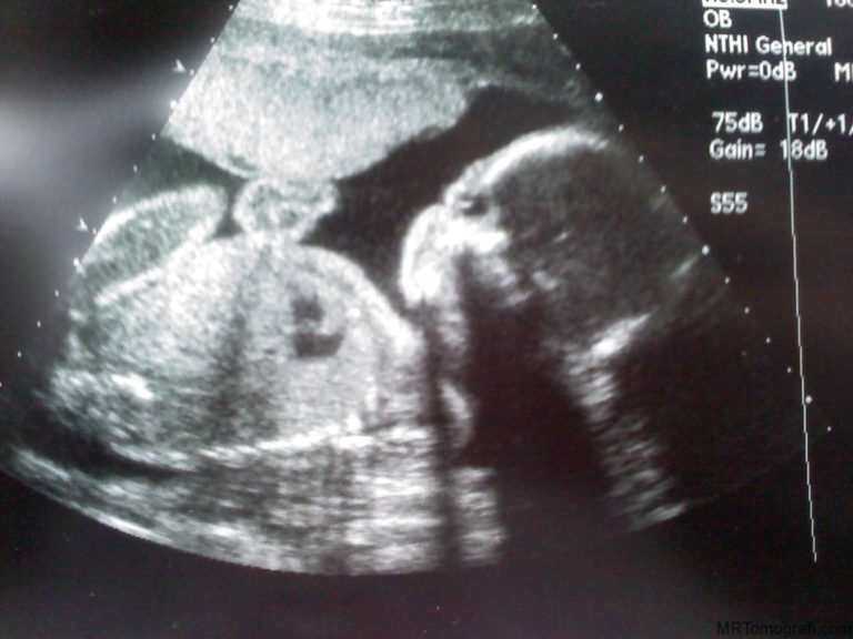 Ultrasonda Gebelik Kesesi Ne Zaman Görünür? Ay Ay Örnek